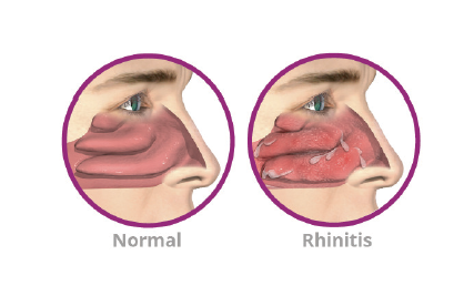 Chronic Rhinitis Treatment